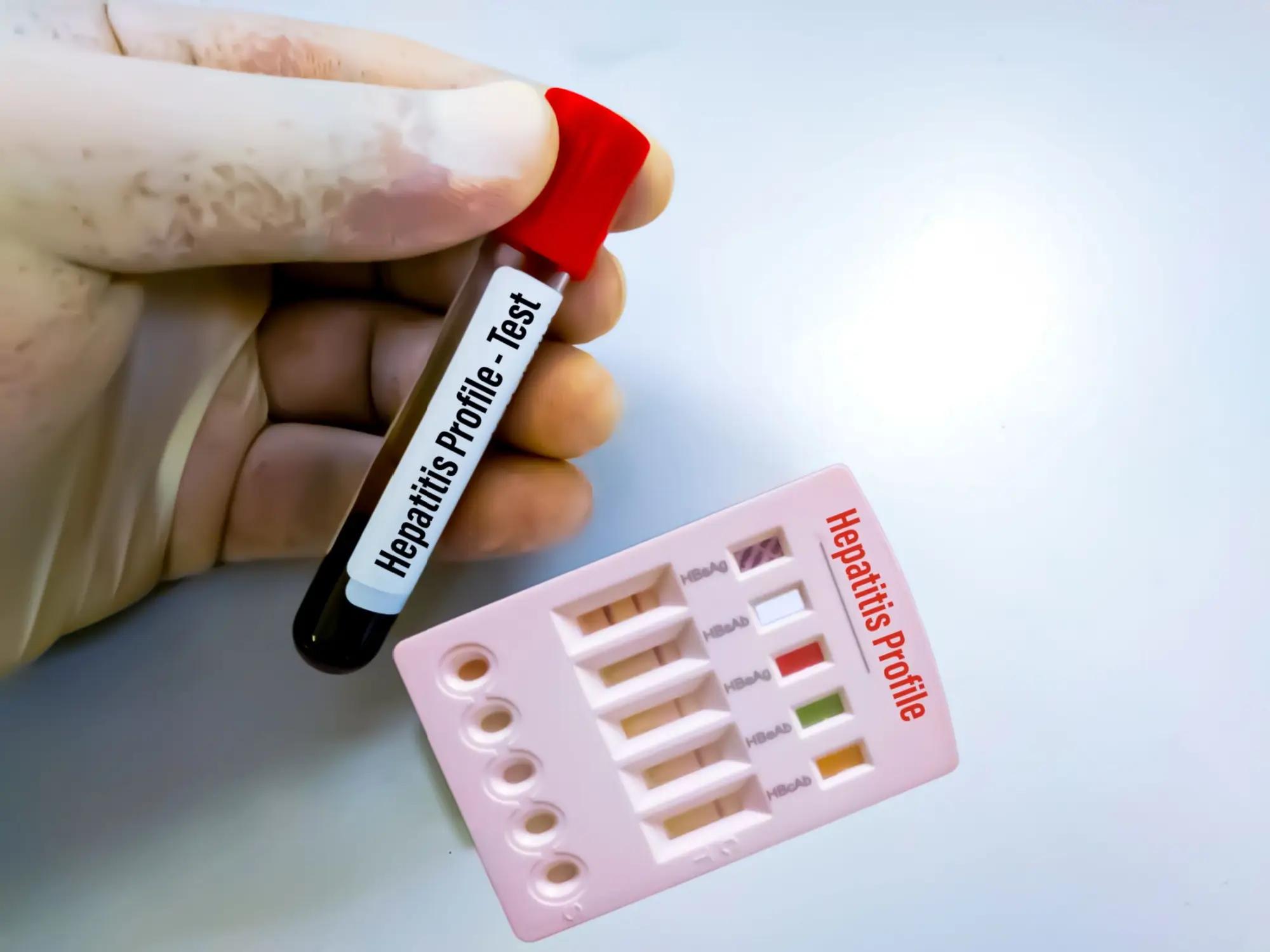 Žloutenka je nebezpečné infekční onemocnění. 